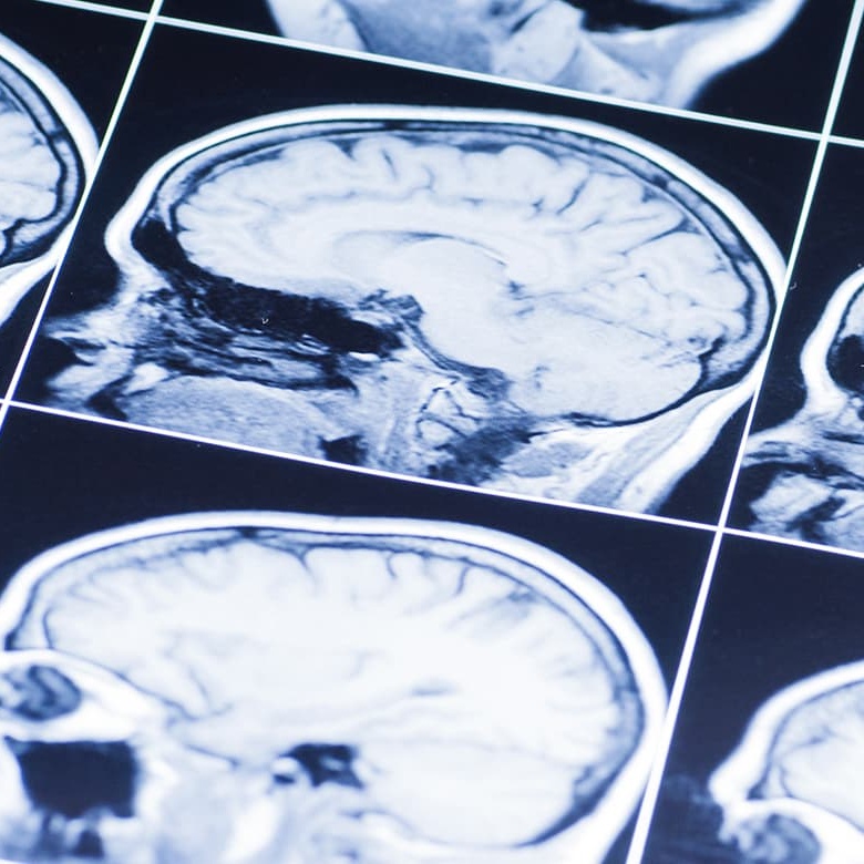 Brain Injuries Image